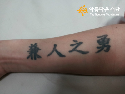 문신제거 1차시술 후