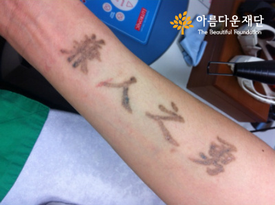 문신제거 4차 시술 후